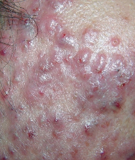 长治有没有治疗囊肿结节性痤疮的医院啊 急!!!